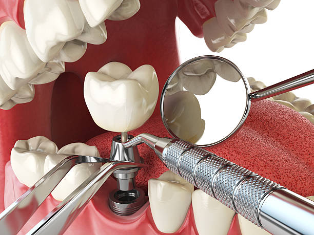 Best Emergency Tooth Extraction in Belleville, PA